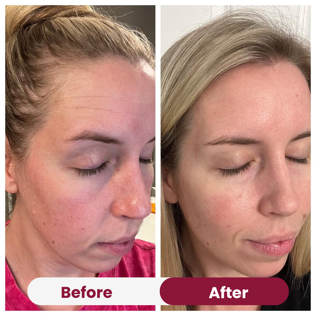 Wrinkle Forehead Patch