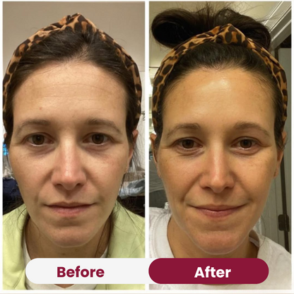 Wrinkle Forehead Patch