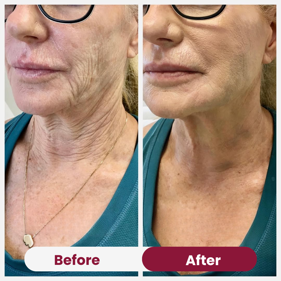 Valentine's Lift & Glow Bundle