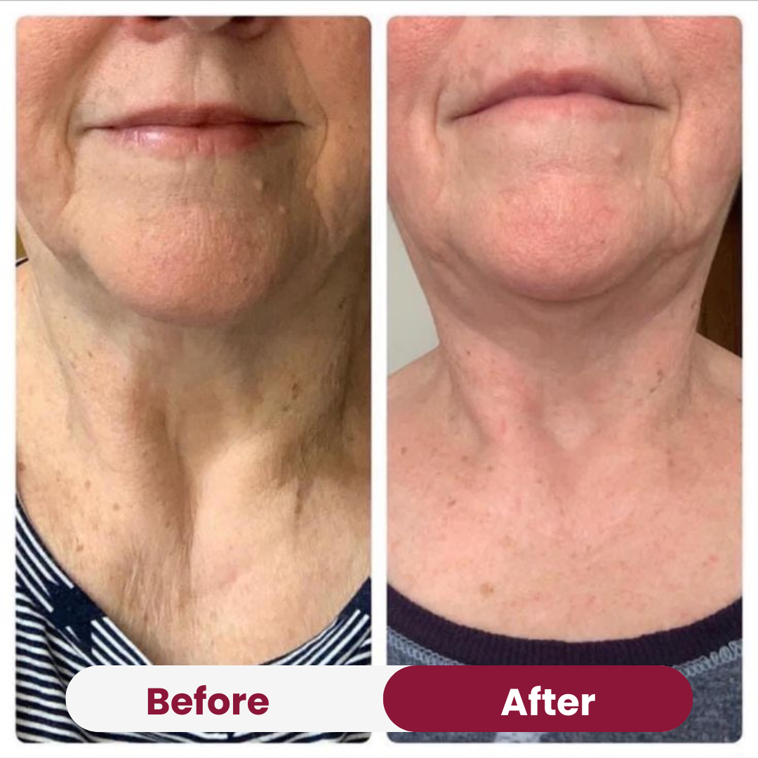 Valentine's Lift & Glow Bundle